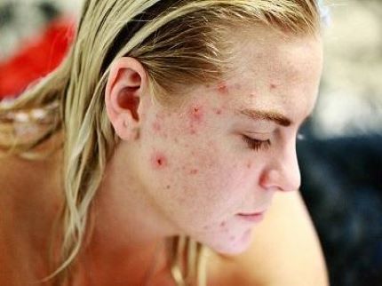 acne, acne treatment, skincare